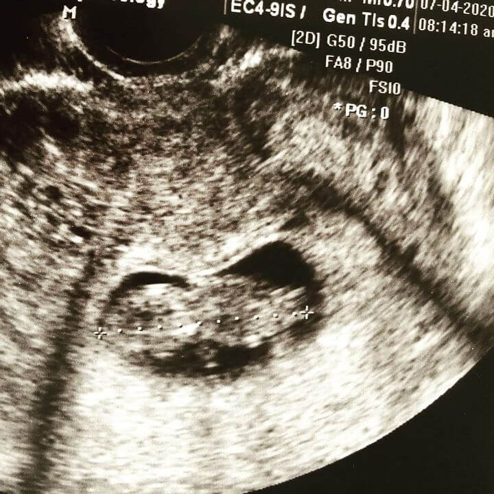 The First Ultrasound