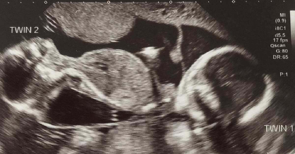 Die Schwangerschafts-Reise einer Mutter führt zu "Wunder"-Zwillingen