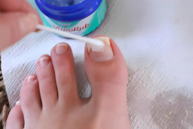 Eradicate Toe Nail Fungus