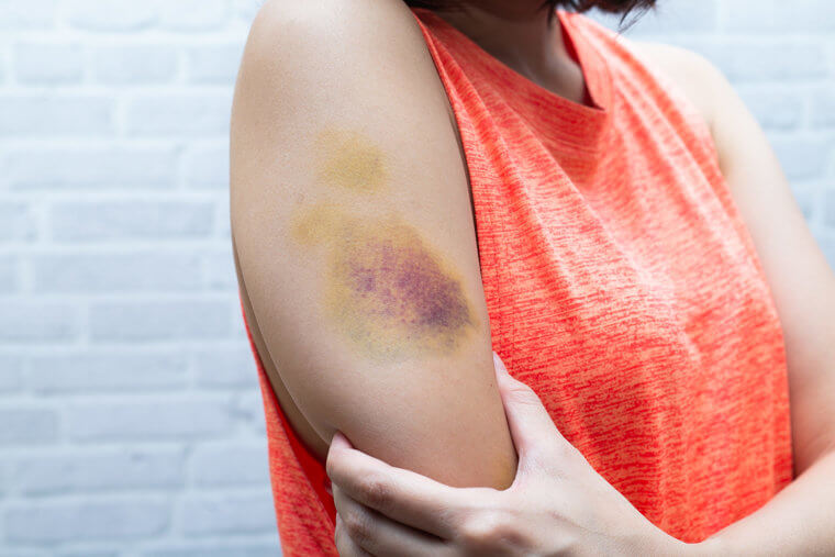Heal Bruises