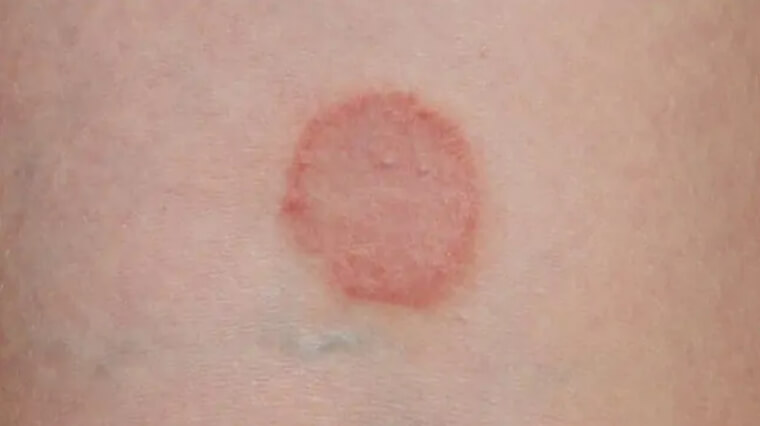 Heal Ringworm