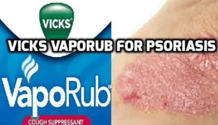 An Alternative Eczema and Psoriasis Treatment