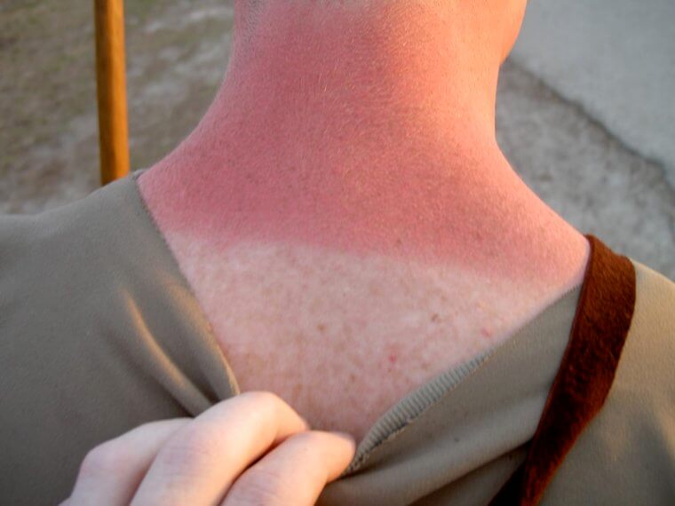 Ease Sunburn