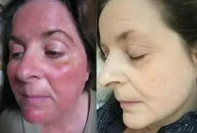 Soothe Rosacea
