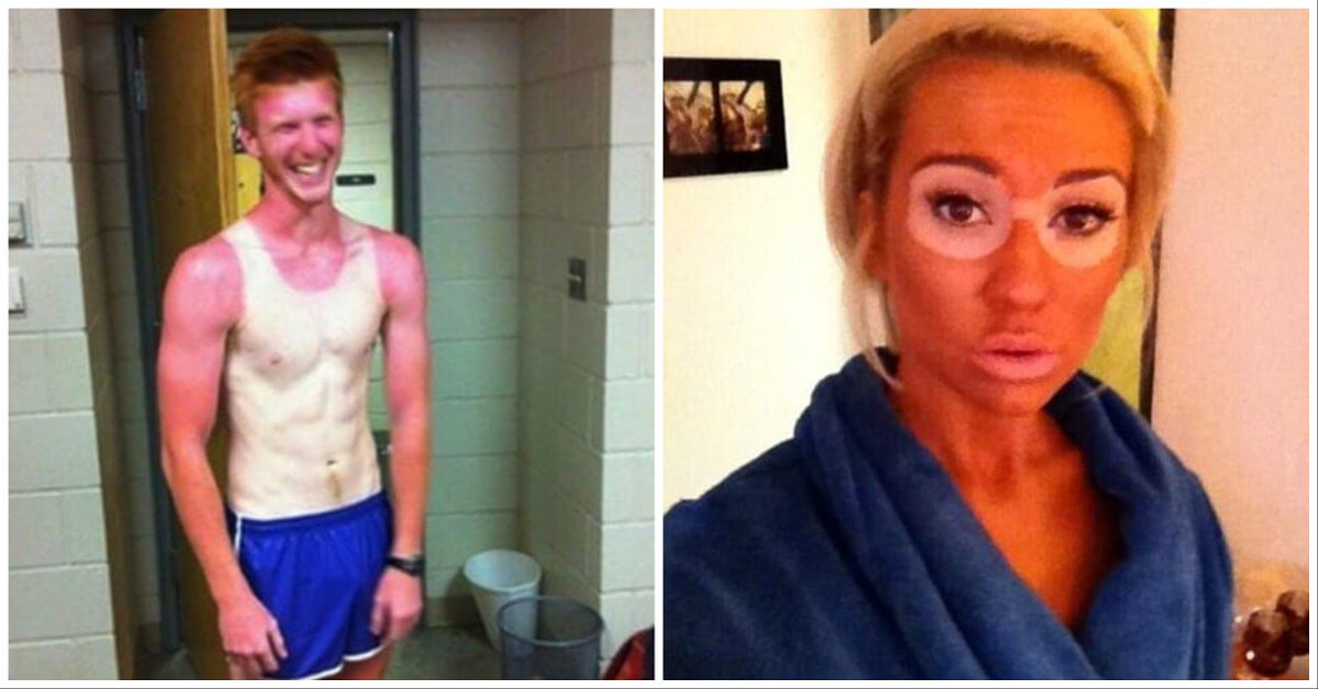 30 Epic Tanning Fails Thatll Have You Saying Pass The Sunscreen Withthefirstpick