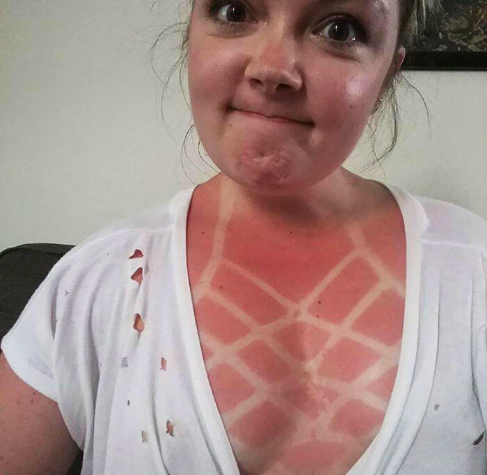At Least The Burn Is Symmetrical