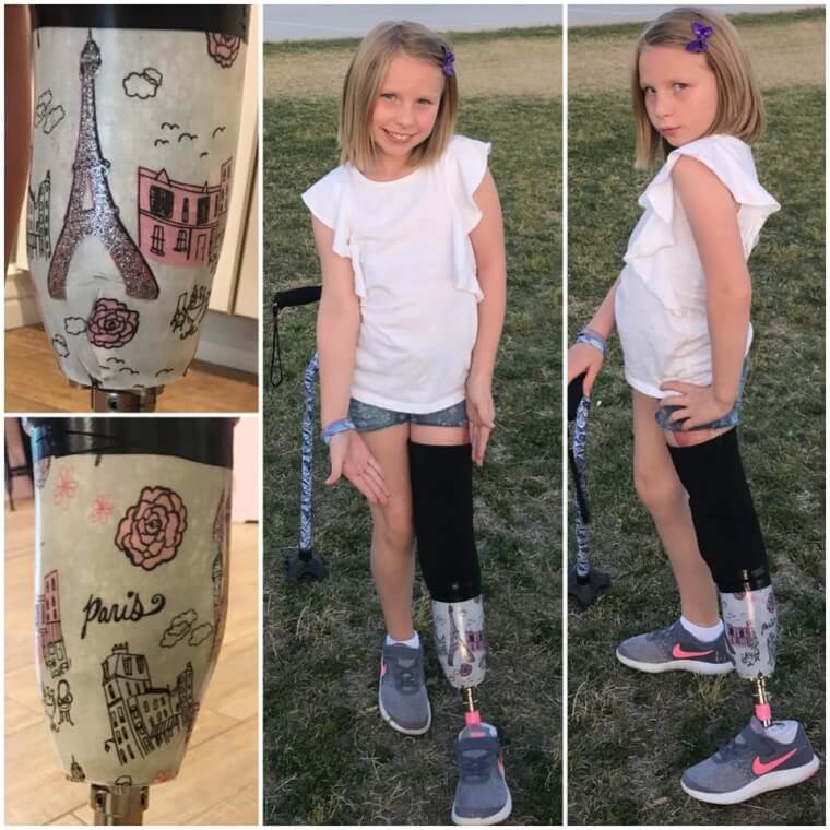 Abri's First Prosthetic Leg