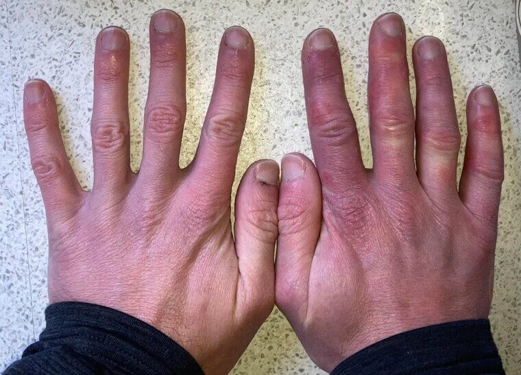 Iowa - Arthritis and Joint-Related Conditions