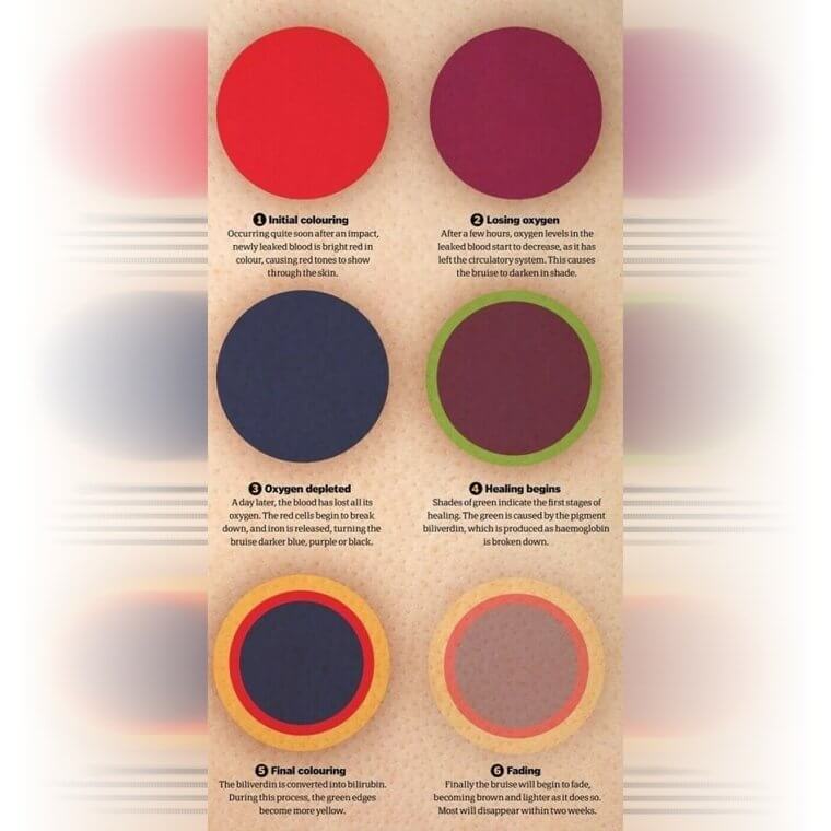 All the Stages of a Bruise and What to Expect