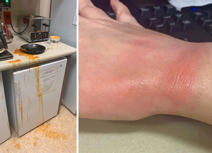 Got Scared By The Toaster And Spilled Boiling Soup On His Hand