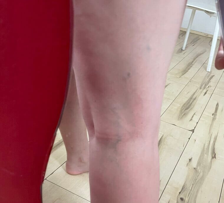 The Horrors of Varicose Veins