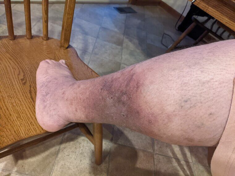 Blood Clots and Deep Vein Thrombosis