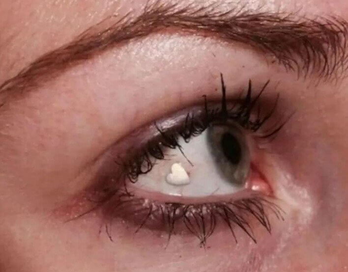 Eyeball Implants - Netherlands