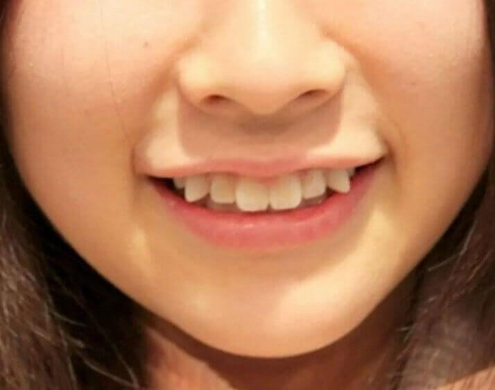 Crooked Teeth - Japan