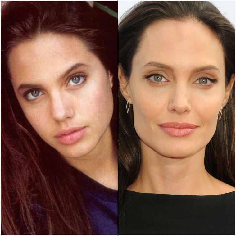 Angelina Jolie Went for Everyone's Favorite Procedure