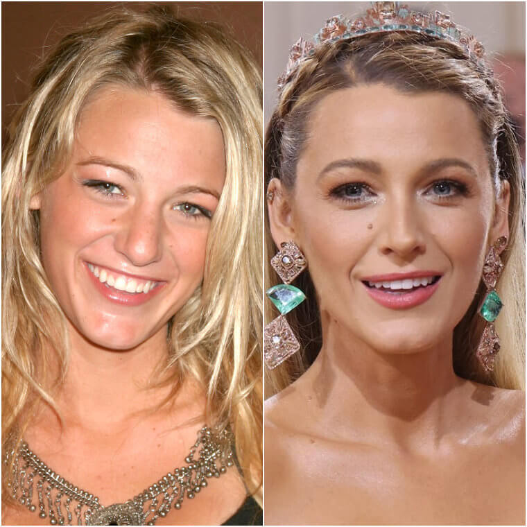 How Come We Never Noticed Blake Lively Had So Much Work Done?