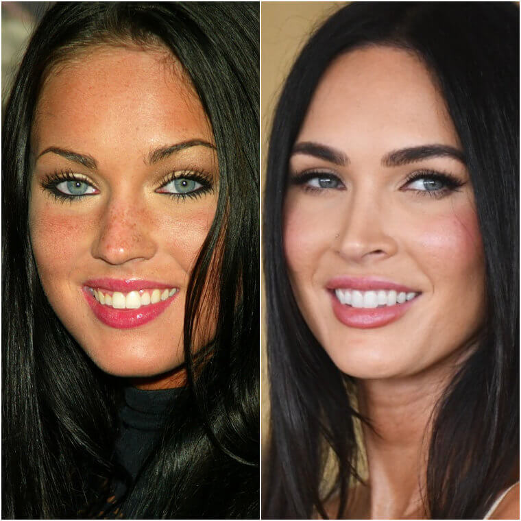 Megan Fox Is Probably Not Against Plastic Surgery Anymore