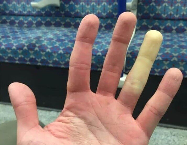 寒いと薬指がこうなる。