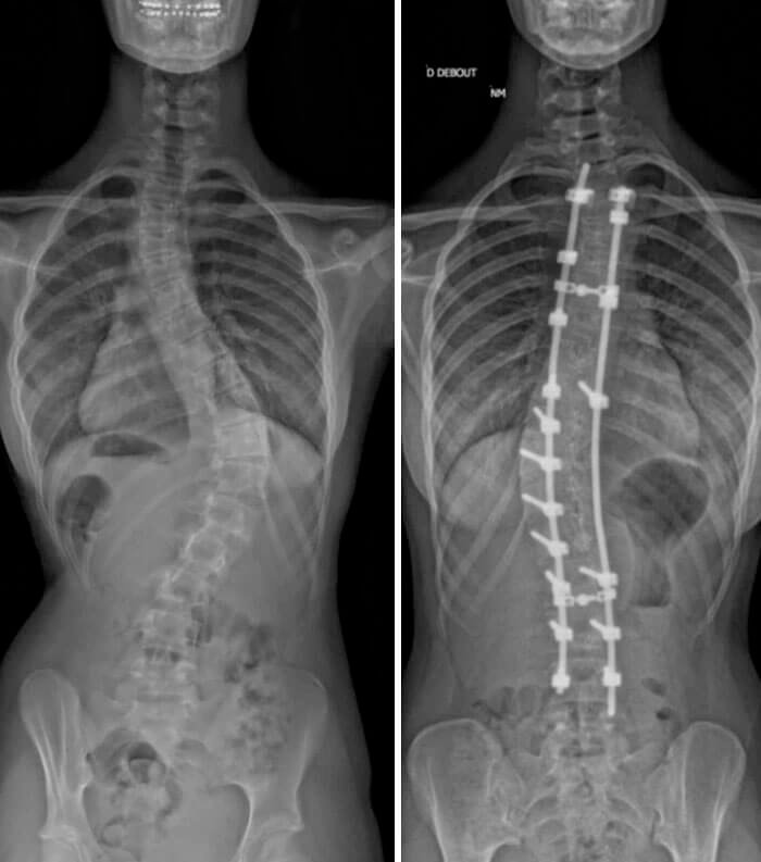 Resultado de una cirugía de enderezamiento de la columna vertebral