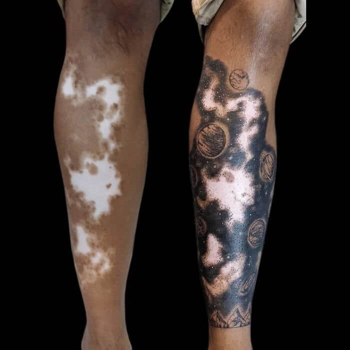 Is This Vitiligo, Or A Tattoo?