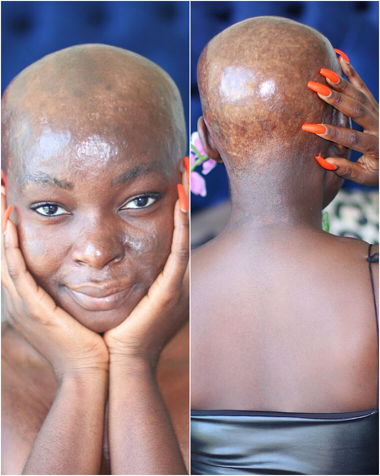 Shalom Nchom - the Makeup Guru Who Doesn't Need Makeup to Cover Her Burns