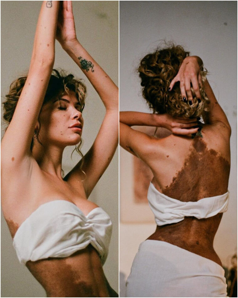 Yulianna Yussef Has Moles Covering 60%-70% of Her Body - and She's Proud of It