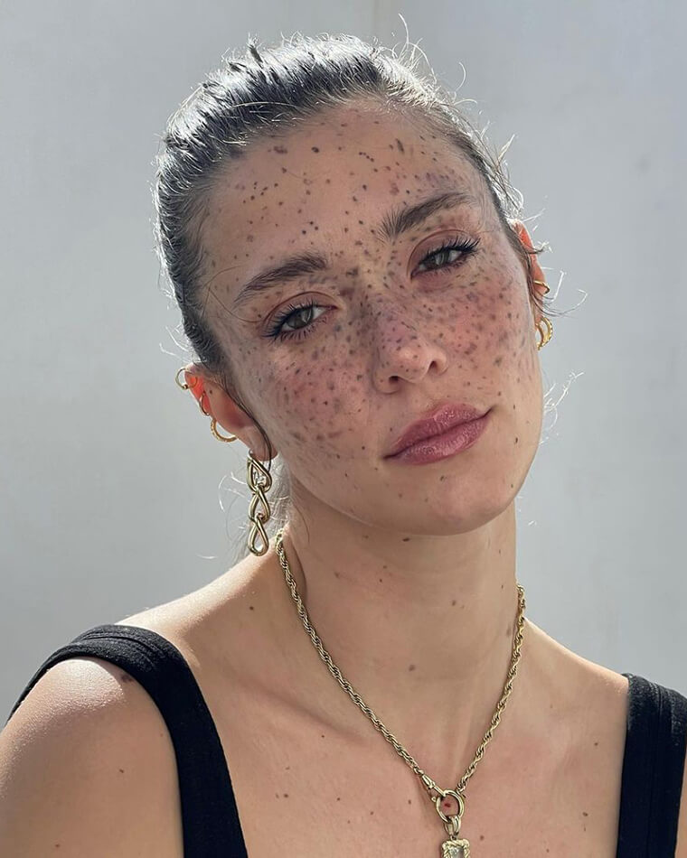 Maeva Marshall's Stroke Led to Second-Degree Burns - and It Made Her a Model