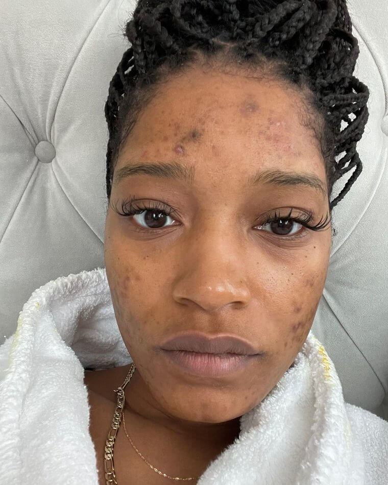 Keke Palmer Opens Up About Health
