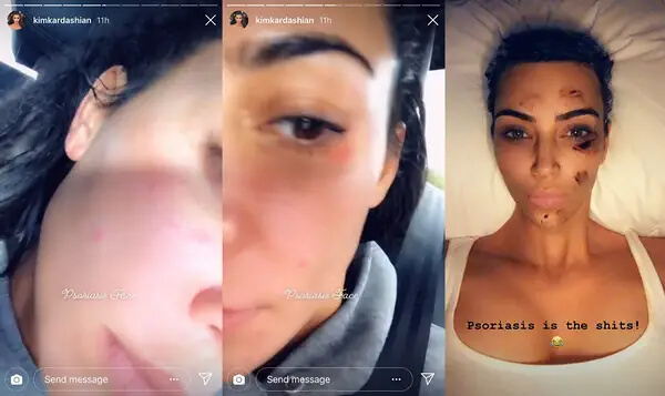 Kim Kardashian Posts About Psoriasis