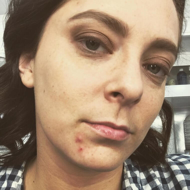 Rachel Bloom Opens Up About Stress And Acne