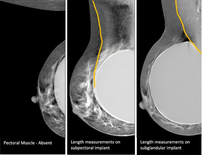 Mammogram Imaging Of Breast Implants