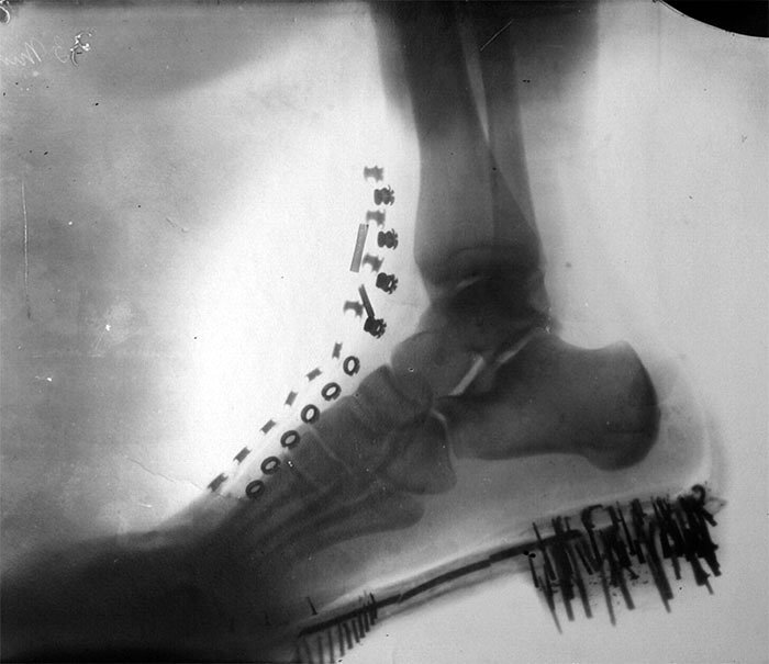 Nikola Tesla's Foot In 1896
