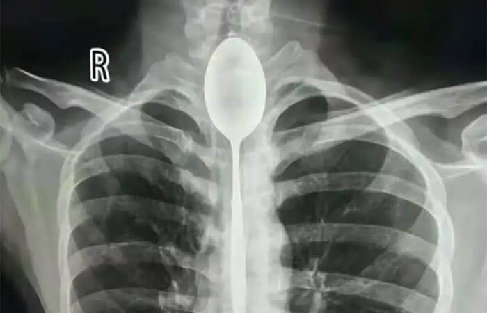 Doctors Found A Steel Spoon In This Man's Esophagus