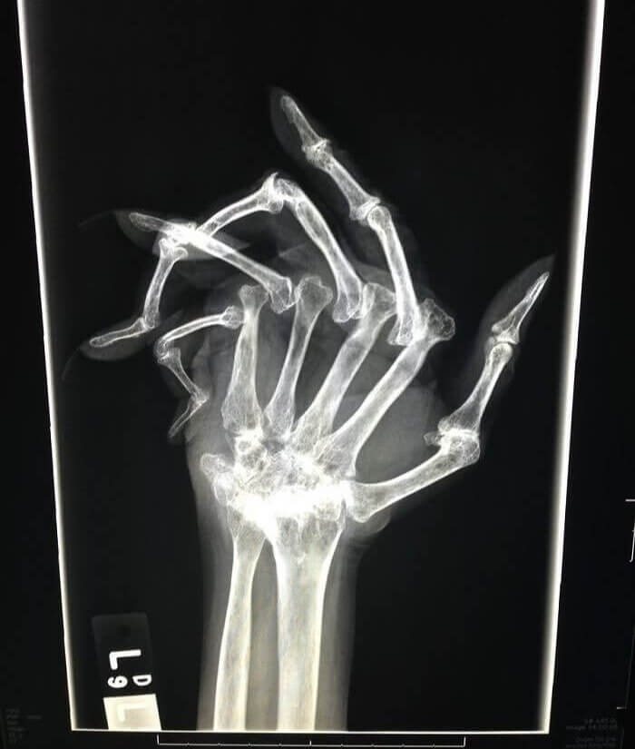 Advanced Rheumatoid Arthritis Underneath An X-Ray