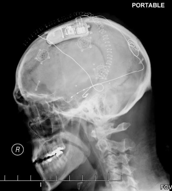 This Device Detects And Treats Seizures