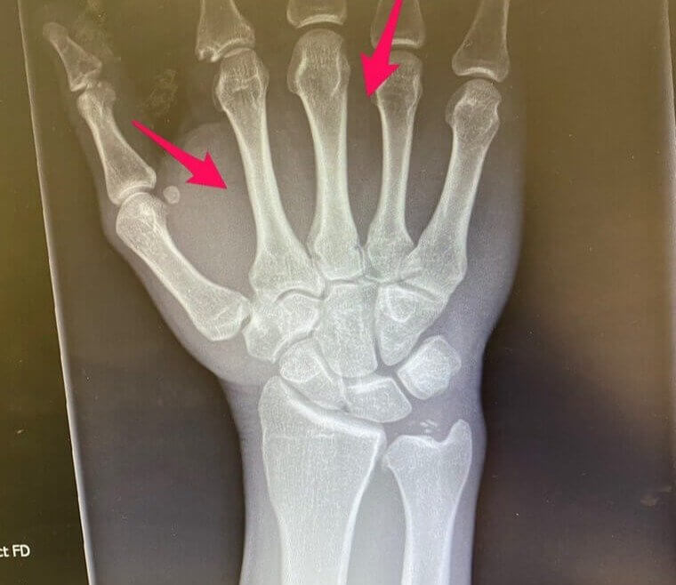 Bone Density In A Fighter's Hand