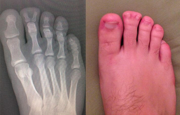 Getting An X-Ray Of All Six Toes