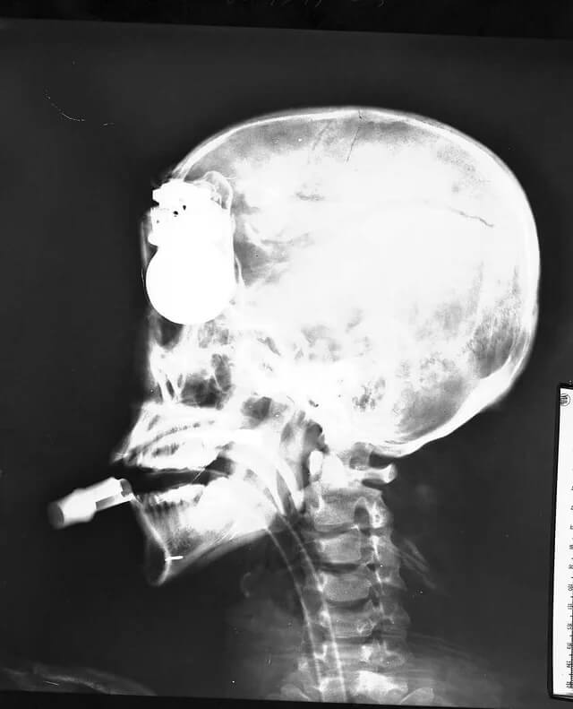 A Grenade Stuck In U. S. Soldier's Head In Vietnam