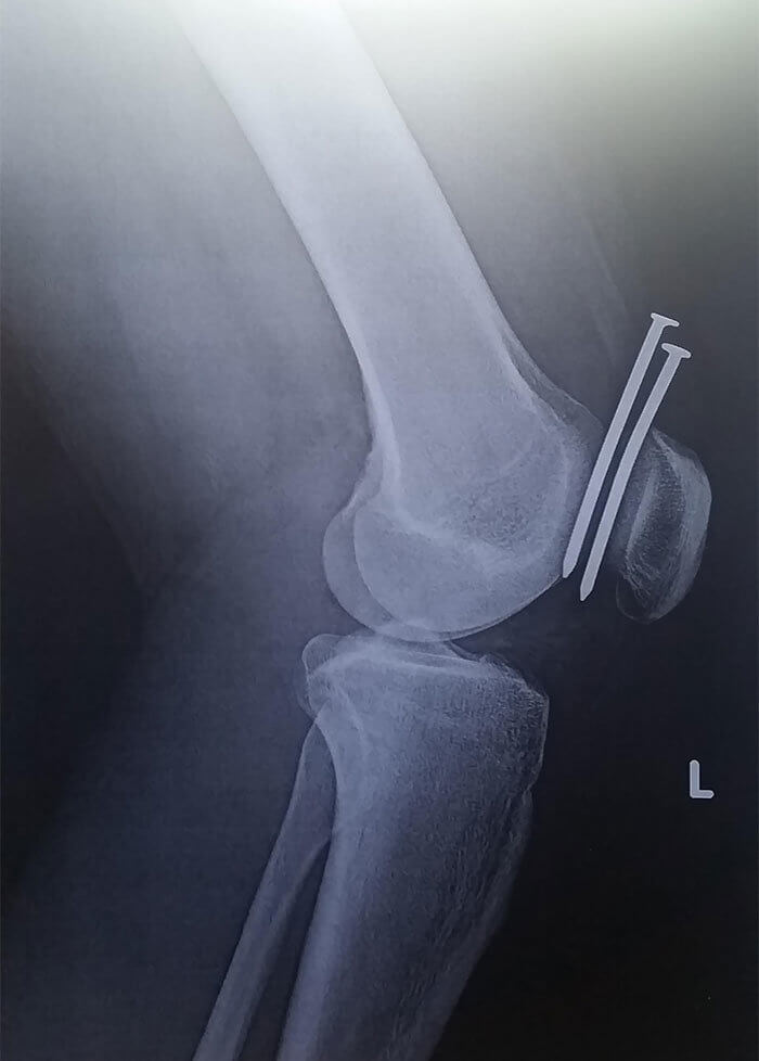 Injuries From A Nail Gun