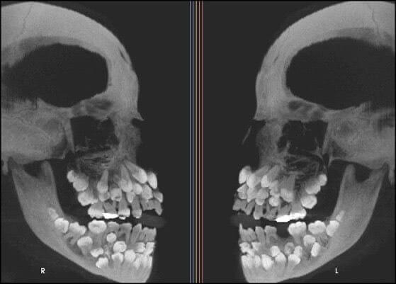 Why Toddlers Have Incredibly Terrifying X-Rays
