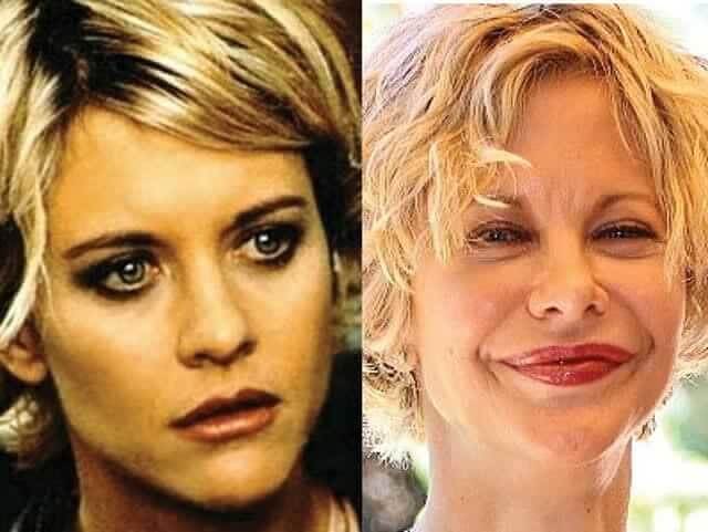 Meg Ryan – $11,750: Why the "Sleepless in Seattle" Star Thinks the Surgery Talk Is "Not That Interesting"