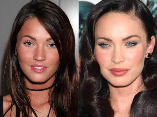Megan Fox – $8,000 - Loves to Use "every Laser Imaginable"