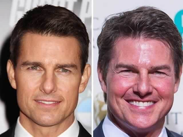 Tom Cruise – Unknown - Once Told Playboy Magazine That He'd Never Go Under the Scalpel