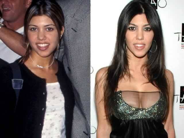 Kourtney Kardashian – $25,000: She Stopped Botox to Keep Her "Third Eye" Open