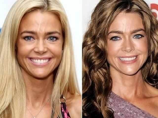 Denise Richards – $13,000: Her Husband Hurt Her Post-Surgery