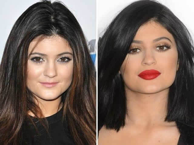 Kylie Jenner – $2,000,000: Got Lip Fillers After a Mean Comment From a Date