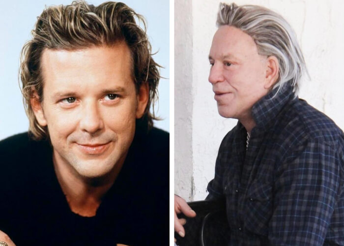 Mickey Rourke – $36,000: Had to Have Corrective Procedures After Bad Surgeries