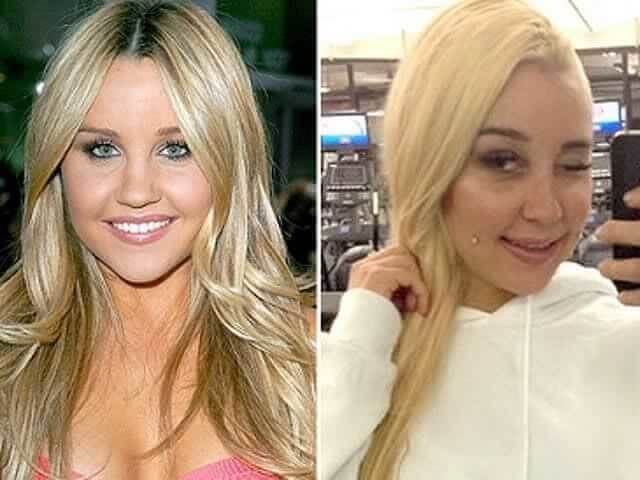Amanda Bynes – $18,000: “I Plan on Having Surgery on My Whole Face"