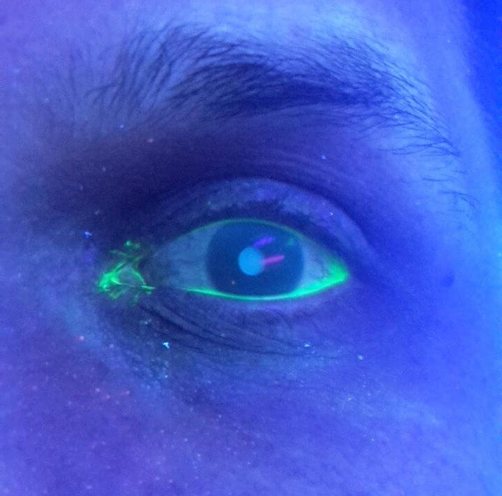 A Scratched Cornea Under UV Light