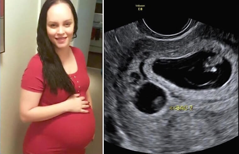 The Pregnancy Was Going Well